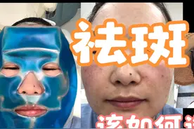皮秒祛斑脱痂了，目前效果可以，希望不要反黑视频封面