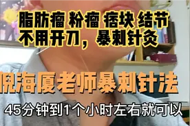 倪海厦老师暴刺针灸实战，花生米大小脂肪瘤，一次针灸基本消失。