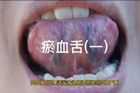 瘀血舌（一）视频封面