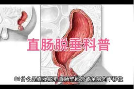直肠脱垂科普@中视频伙伴计划官号视频封面