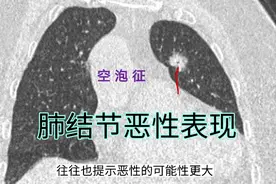 磨玻璃结节，5个细节提示肺癌，医生细说CT片视频封面