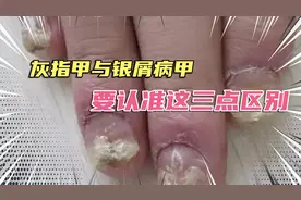 【灰指甲与银屑病甲】指甲凹陷、发黑、瘙痒！及时止损避免误诊视频封面