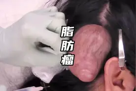 头上长了一个拳头大小的肿块原来是这…视频封面