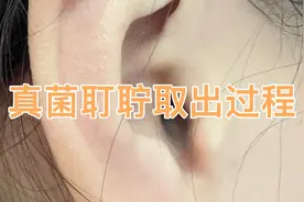 真菌性外耳道炎耵聍取出过程