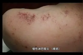 慢性淋巴腺炎（'瘰疬）的原因及症状