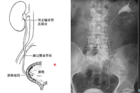 影像知识科普：输尿管三个生理性狭窄讲解，输尿管结石病例分享视频封面
