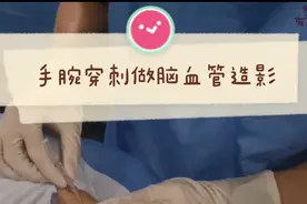 从手腕穿刺做脑血管造影，做完就可以立即出院！视频封面