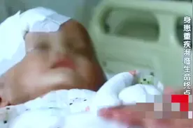 一岁男婴头重十五斤，大脑里百分之九十全是积水！视频封面
