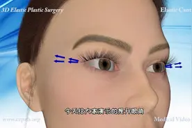 面部整容之 怎么开眼角，3D演示。。视频封面