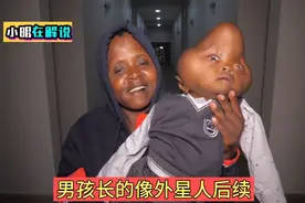 男孩长的像外星人后续：男孩到大医院接受治疗，情况不容乐观视频封面