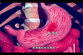 经常左上腹痛，看看胃溃疡的发生原因和治疗方法，3D演示。。视频封面