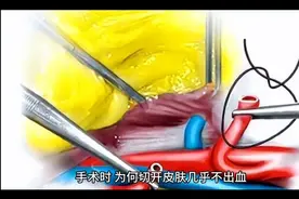 手术时，为何切开皮肤几乎不出血，生活中稍微划破就会流血呢视频封面