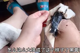 这“黑膏药”太神奇啦 看着恶心效果真不错 腰疼腿疼等都可以一试视频封面