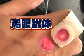 治疗疣体液氮冷冻手术过程。视频封面