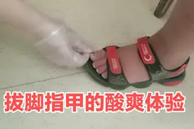 儿子脚趾甲被同学掀开，带他去诊所治疗，拔掉指甲那刻痛苦又酸爽视频封面