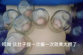 拔罐瘦身减肥，客人拔一次瘦一次 ， 效果太好攒视频封面