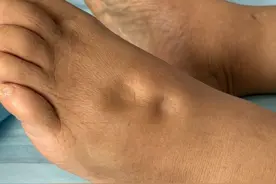 脚上一按一个坑，可能是肾脏受损视频封面