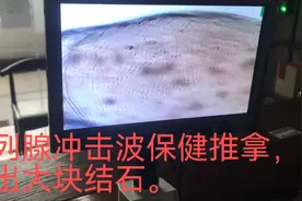 前列腺冲击波保健推拿，排出芝麻大小的结石。视频封面