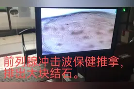 前列腺冲击波保健推拿，排出芝麻大小的结石。视频封面
