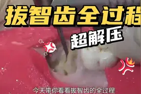 解压视频！拔智齿全过程，只是看看就感受到了酸爽~超解压视频封面