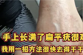 手上长满了扁平疣很难看，我用一招方法祛除的干干净净视频封面