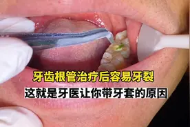 仁义牙医集团王秋生医生科普：根管治疗后 牙齿需要带牙冠保护。视频封面