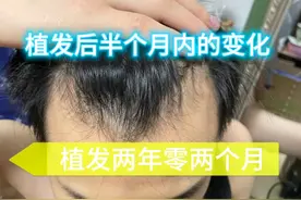 植发两年零两个月了，给大家看看我植发后半个月内的变化视频封面