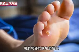 得了鸡眼不要害怕，可以用这几种方法治疗视频封面