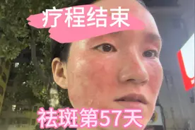 祛斑第57天结束疗程，下周三部门团建哦，幸好赶在团建之前洗脸了视频封面