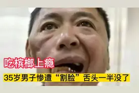 槟榔一级致癌物，35岁男子吃槟榔上瘾，惨遭“割脸”舌头一半没了视频封面