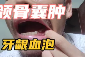 颌骨囊肿手术切除牙周病根管治疗，不痛不痒的牙龈血泡中医怎么治视频封面