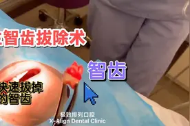 5分钟拔除智齿全过程，医生提示说最快可以这样拔智齿！建议收藏视频封面