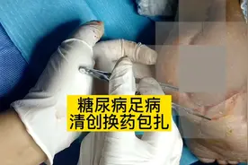 糖尿病并发症足部皮肤溃烂并感染视频封面