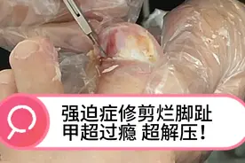 小姐姐脚趾头灰指甲都烂掉了修剪烂脚趾超过瘾超解压强迫症进来看