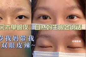 18岁我妈带我去割双眼皮，褪去呆木单眼皮，自然妈生眼会说话✌️视频封面