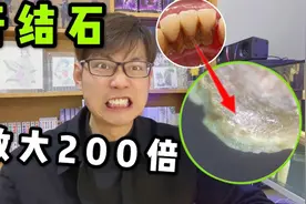 把牙结石用显微镜放大200倍！像一块大岩石！看完赶紧去刷牙！视频封面