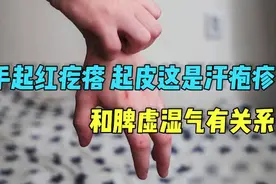 手起红疙瘩 起皮可能是汗疱疹和脾虚湿气有关系视频封面