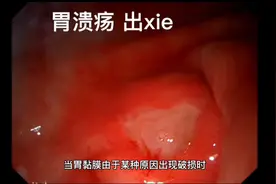 什么是胃溃疡视频封面