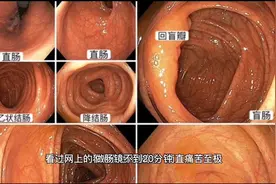 做肠镜疼的要死吗 20分钟 捎带切了个息肉 不到千元视频封面
