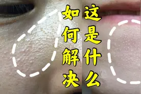 下巴和鼻背上的白色颗粒是什么？如何快速去除？视频封面