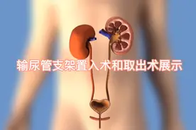 肾结石患者要置入的输尿管支架管原来是这样放进去的视频封面