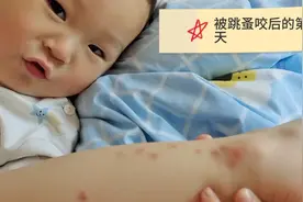 两岁半宝宝，被跳蚤咬后的反应，令人费解！