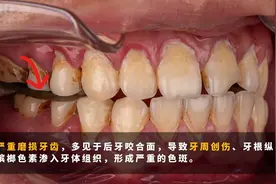 长期嚼槟榔对牙齿的危害有多大 #牙齿美学修复全瓷贴面#视频封面