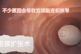 高清动画展示宫颈扩张术！前方高能视频封面