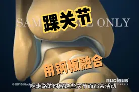 踝关节植骨融合内固定视频封面