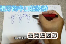 图解告诉你什么是种植牙的粘接连桥视频封面