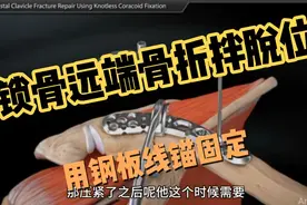 锁骨远端骨折拌肩锁关节脱位用钢板拉袢解决视频封面