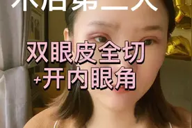 双眼皮全切加开内眼角手术，术后第三天分享全过程，真实记录视频封面