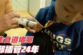 纪录片：女孩天生食道堵塞，水都喝不了，胃部插管24年，伤痕累累视频封面