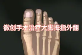 微创手术纠正大脚拇指外翻，看着都疼！视频封面